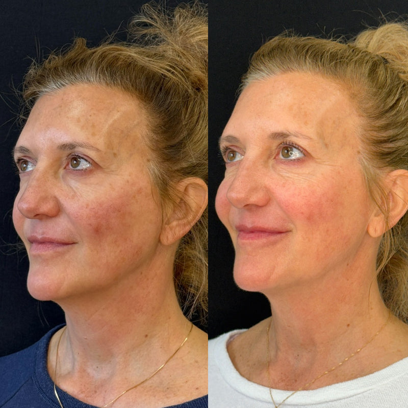 Side-by-side comparison of a woman's face before and after CO2 Laser procedure on a black background.