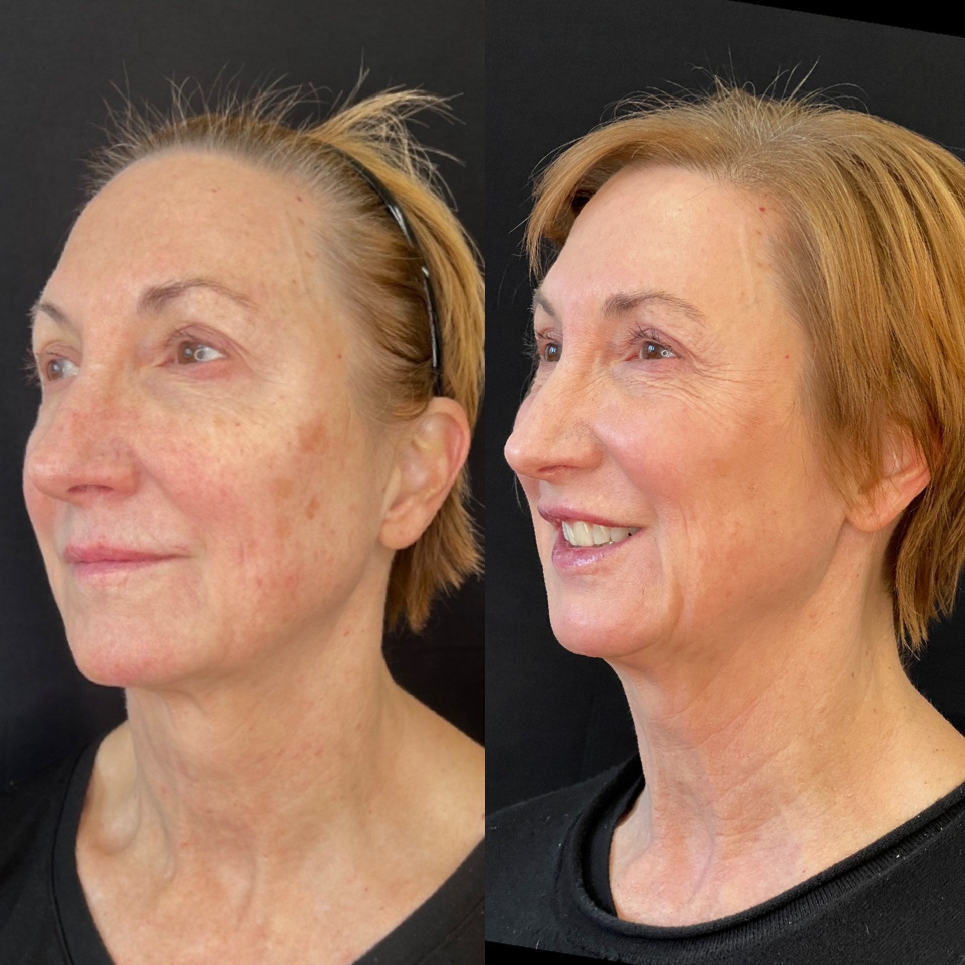 Side-by-side comparison of a woman's face before and after CO2 Laser procedure on a black background.