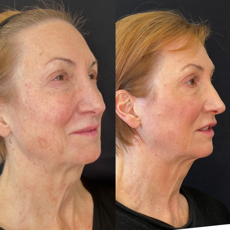 Side-by-side comparison of a woman's face before and after CO2 Laser procedure on a black background.