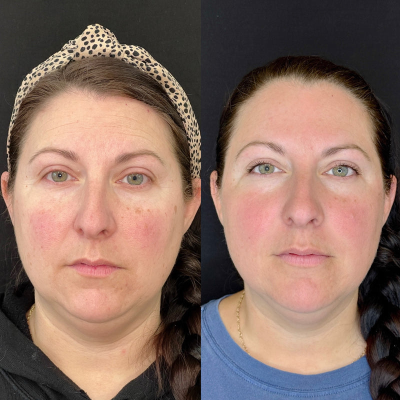 Side-by-side comparison of a woman's face before and after CO2 Laser procedure on a black background.