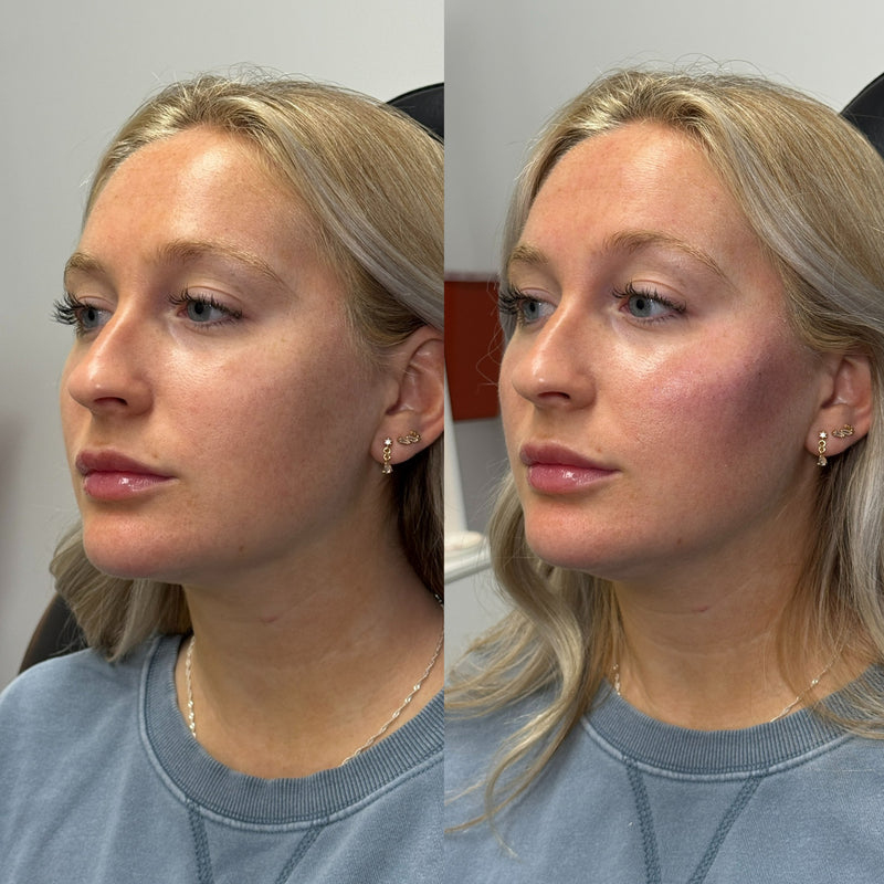 Side-by-side comparison of a woman's face with and without facial dermal fillers.