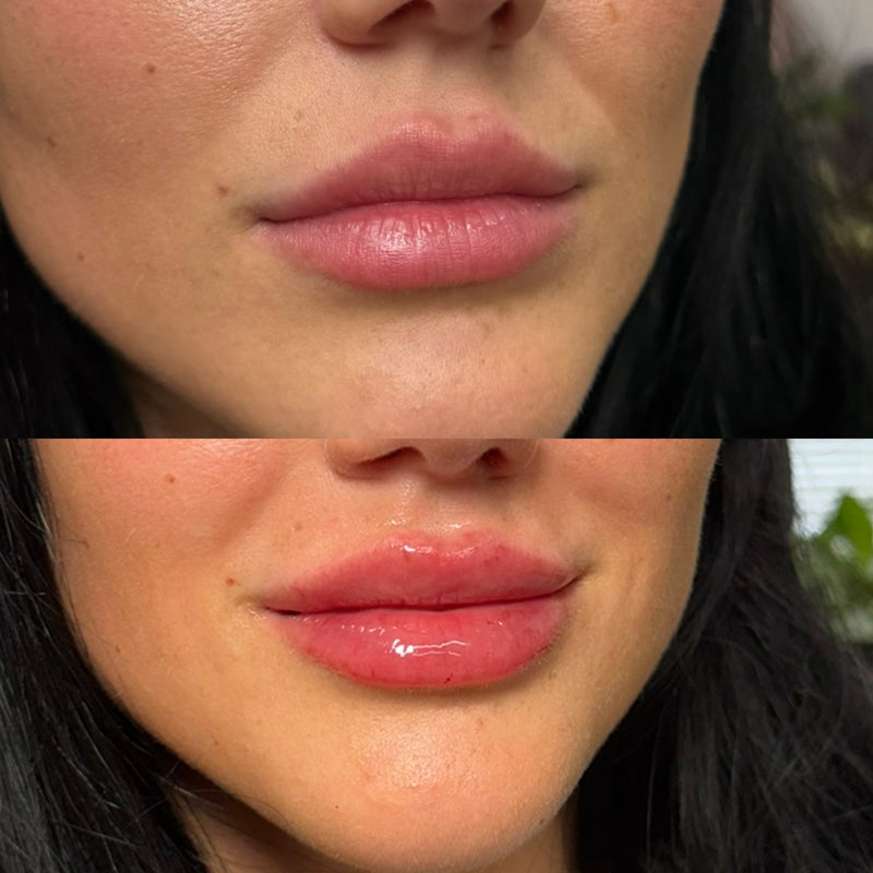 Before and after comparison of a woman's lips with HA filler.
