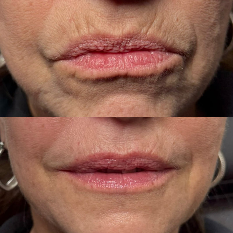 Before and after comparison of a woman's lips and lip lines with HA filler.