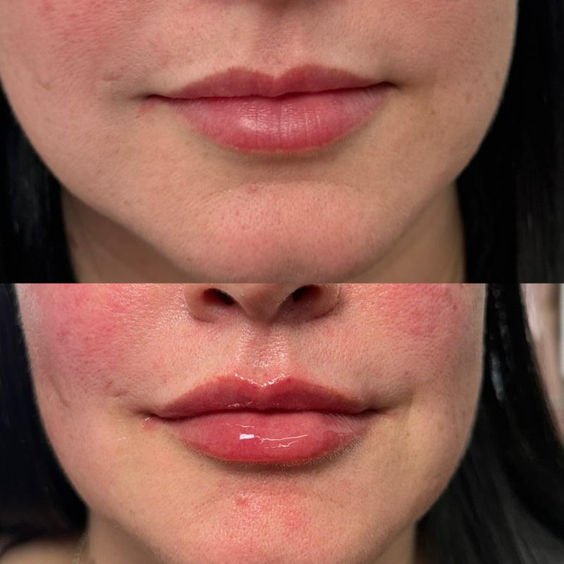 Before and after comparison of a woman's lips and with HA filler.
