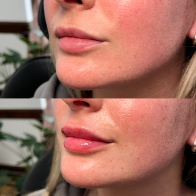Before and after comparison of a woman's lips and with HA filler.