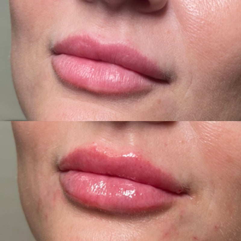 Before and after comparison of a woman's lips and with HA filler.