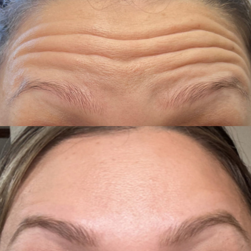 Before and after comparison of forehead lines and skin texture after neuromodulator treatment.