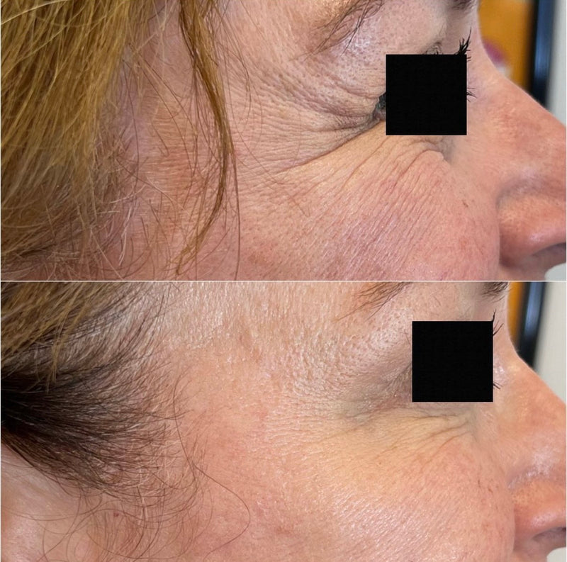 Before and after comparison of forehead lines and skin texture after neuromodulator treatment.