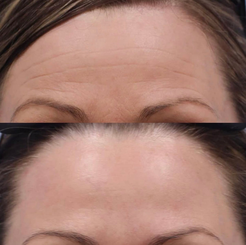 Before and after comparison of forehead lines and skin texture after neuromodulator treatment.