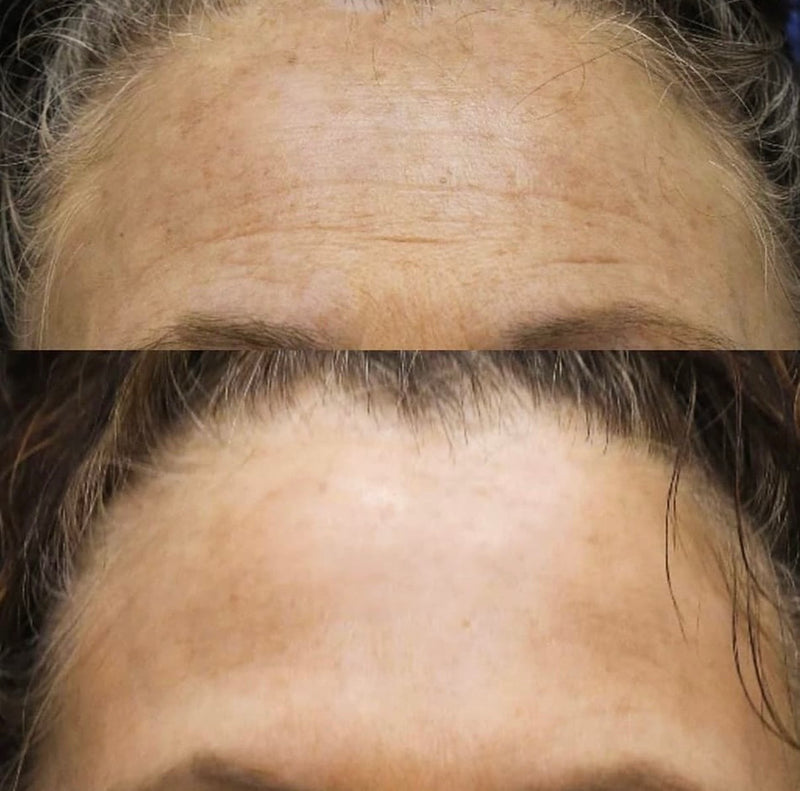 Before and after comparison of forehead lines and skin texture after neuromodulator treatment.