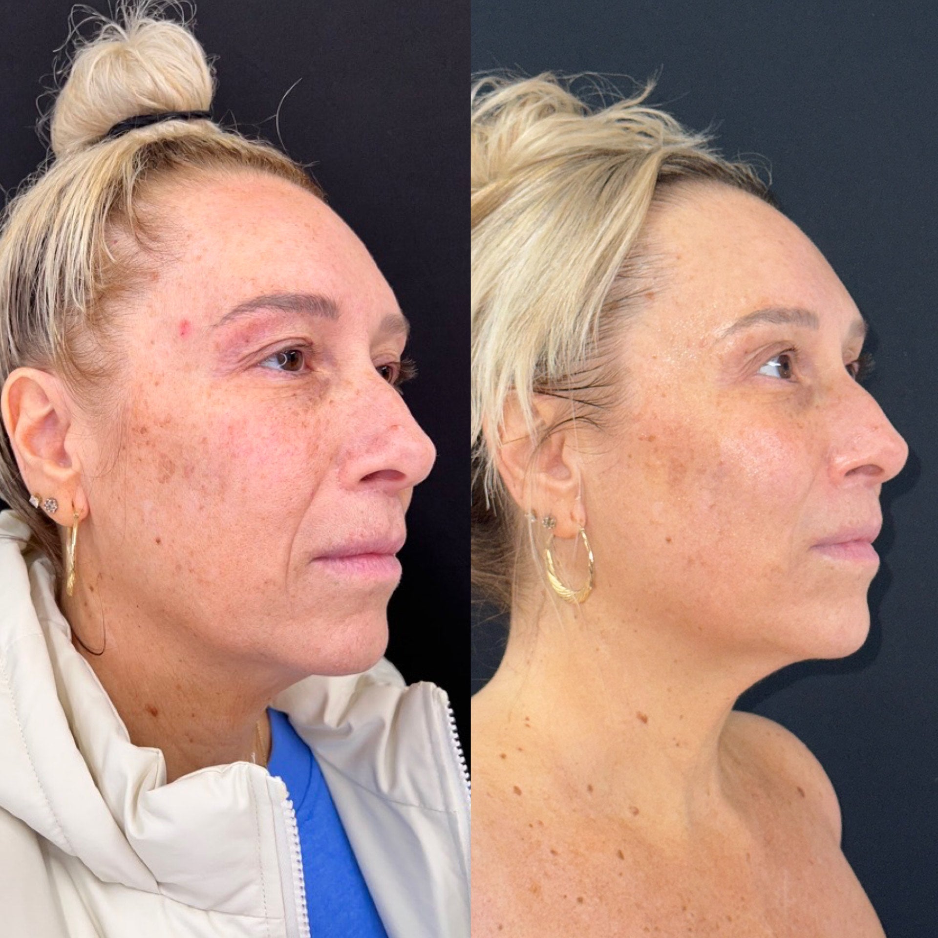Before-and-after comparison of a woman's face before and after SofWave procedure on a black background.