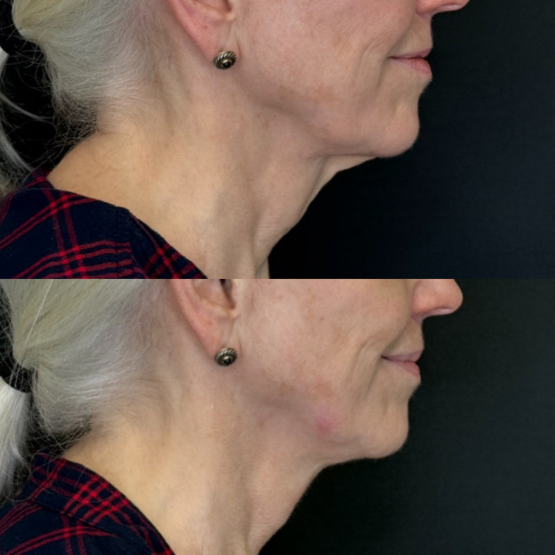 Before-and-after comparison of a woman's face before and after SofWave procedure on a black background.